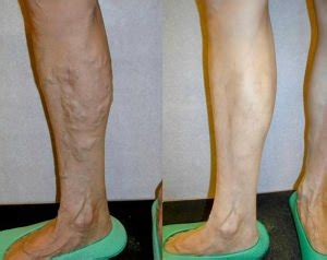 Tratamentul clinic al piciorului pentru varice